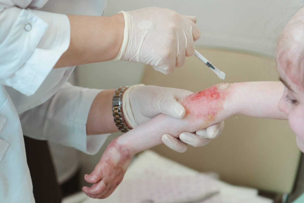 'Butterfly children' to be treated with innovative drug in Dagestan